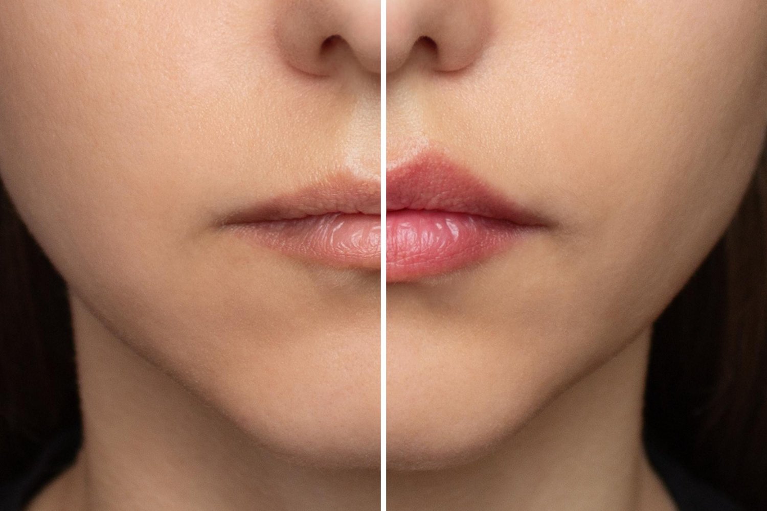 Aumento y Definición de Labios