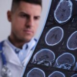 Doctor analizando encefalograma para el estudio de la Epilepsia en adultos jóvenes