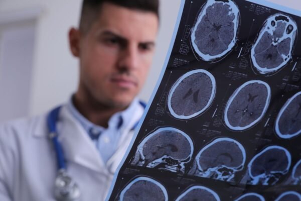 Epilepsia en adultos jóvenes: síntomas menos conocidos y diagnóstico temprano